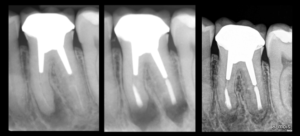 dr brice riera - microchirurgie endodontie