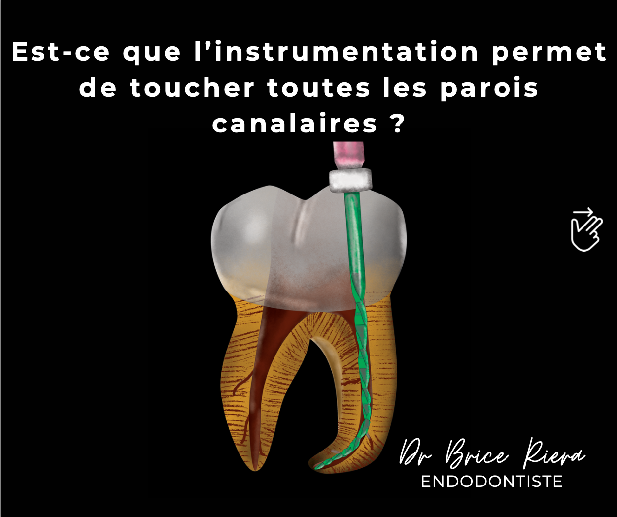 instrumentation et parois canalaires - dr brice riera