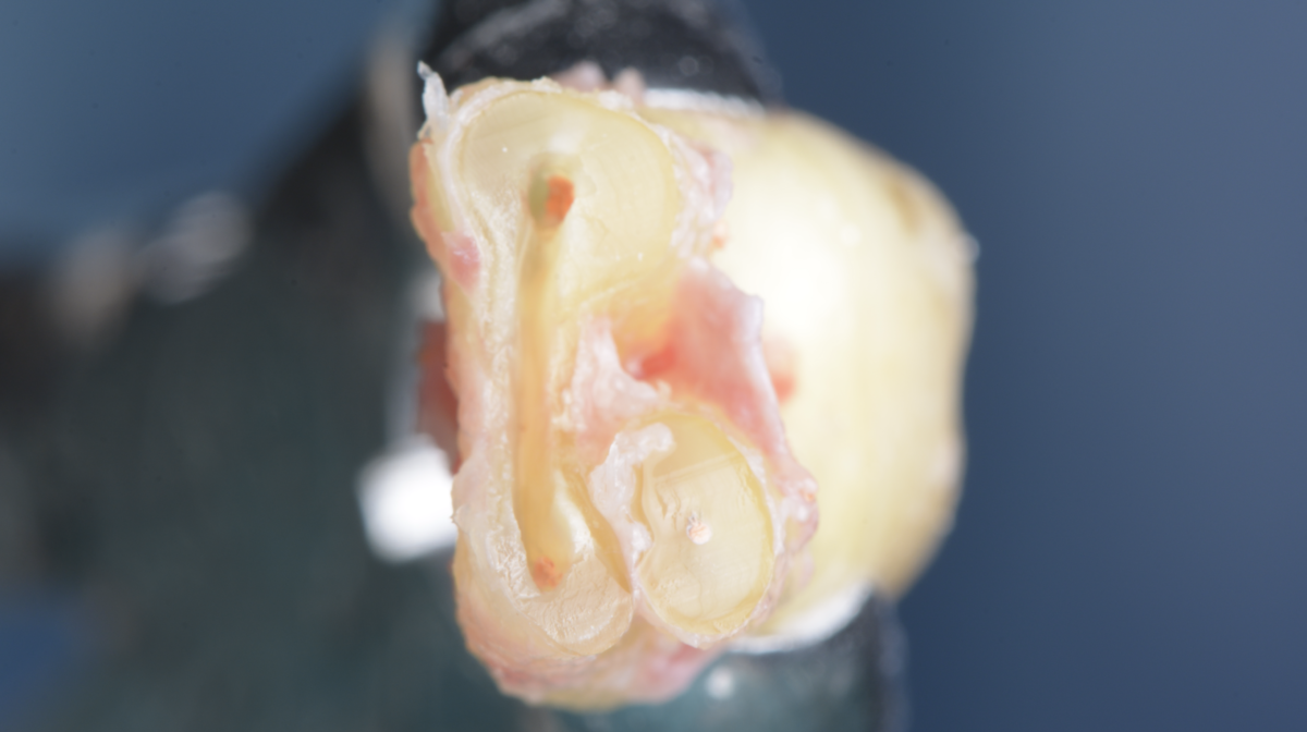 Photo et endo - cas d’une thérapeutique d’extraction : microchirurgie endodontique extra-orale : réimplantation - dr brice riera