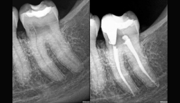 Resorption radiculaire externe inflammatoire - dr brice riera