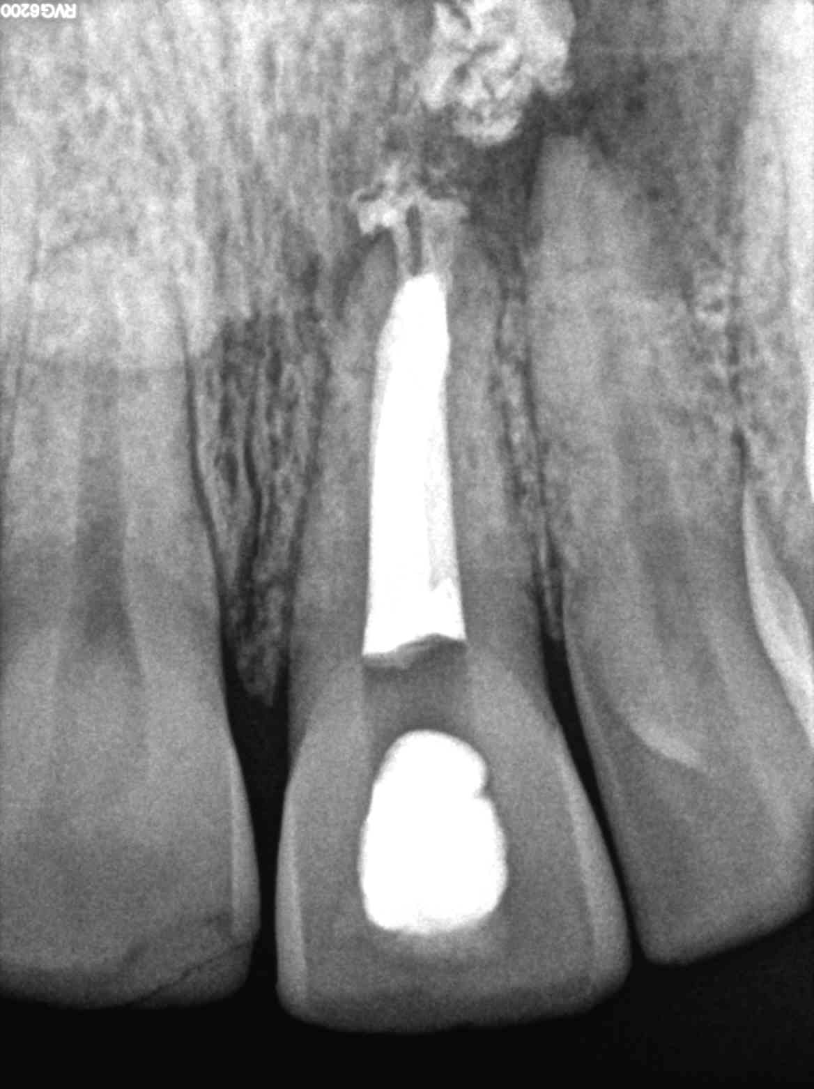 pulpe necrosee et Abcès apical symptomatique - dr brice riera