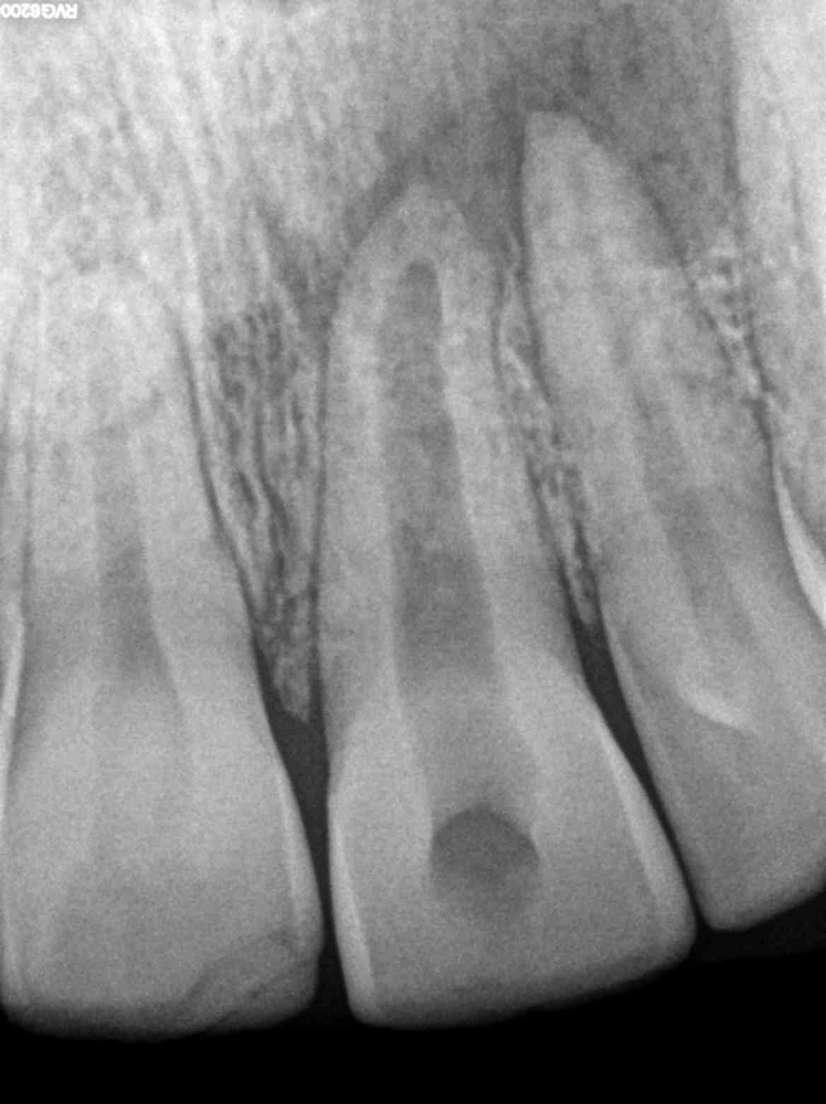 pulpe necrosee et Abcès apical symptomatique - dr brice riera