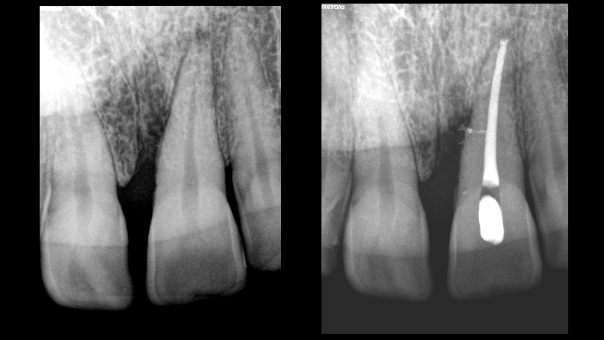 obturation canal lateral - dr brice riera