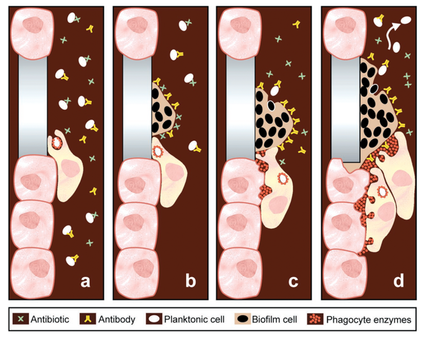 Infections canalaires - dr brice riera