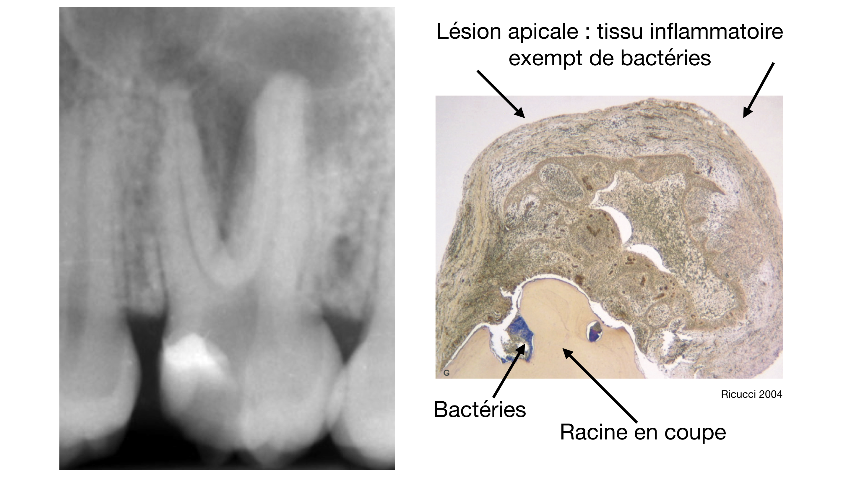 Bacteries dans lésions osseuses 3