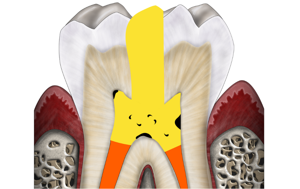 cavité ultra minimalement invasive