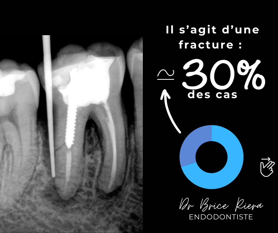 extraire dents traitees1