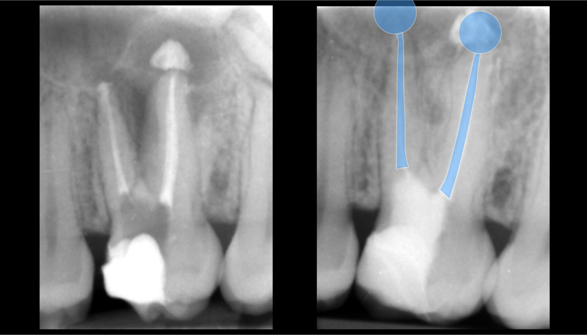 mise en avant - pronostic endodontique