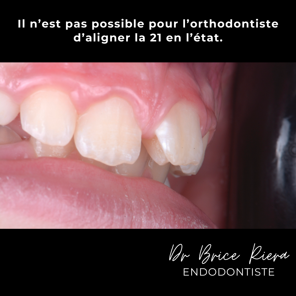 4dr Brice Riera - ODF et endodontie