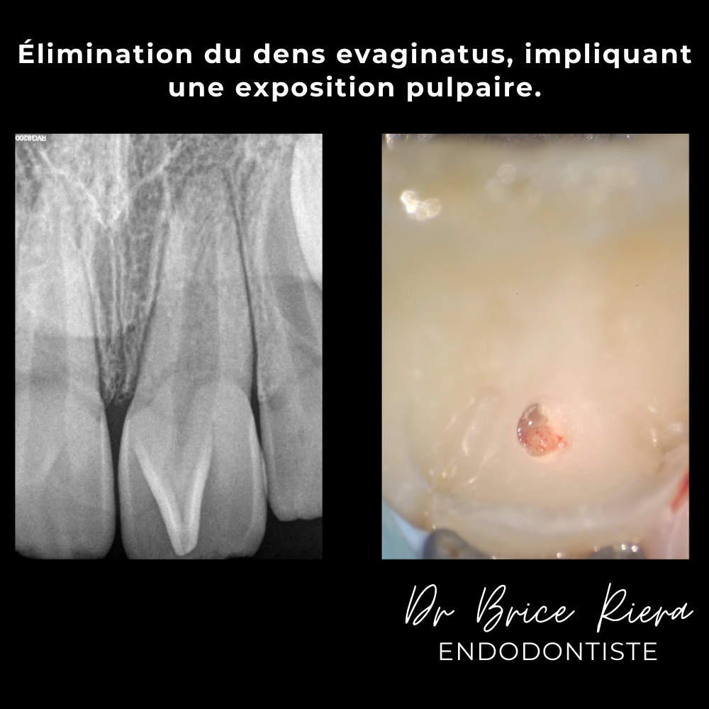 5dr Brice Riera - ODF et endodontie