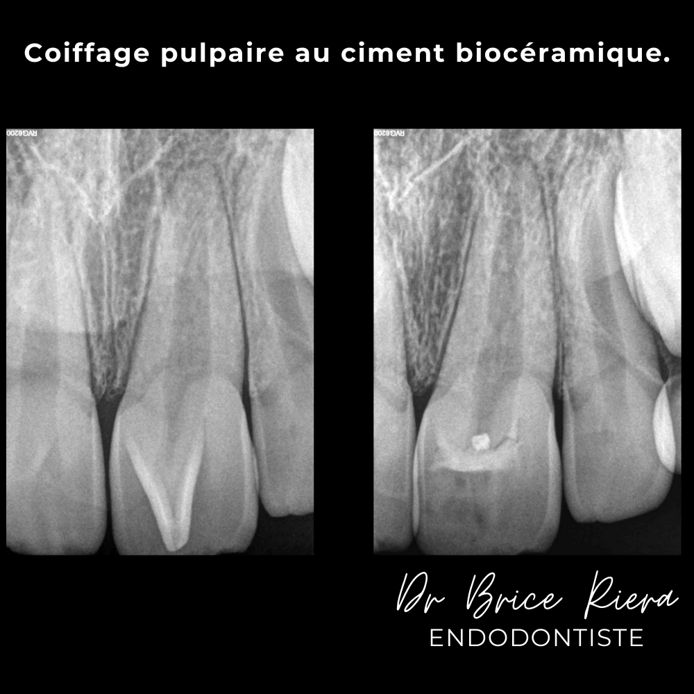 6dr Brice Riera - ODF et endodontie