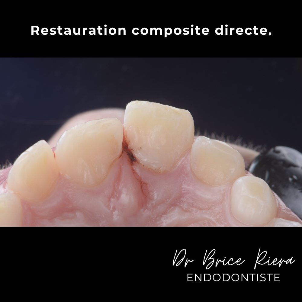 7dr Brice Riera - ODF et endodontie