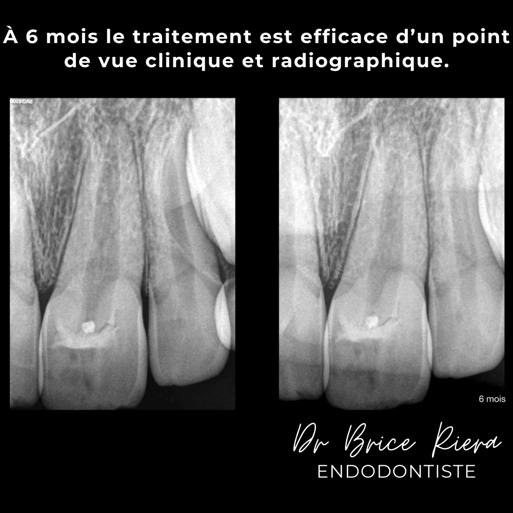 8dr Brice Riera - ODF et endodontie