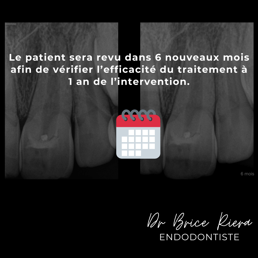 9dr Brice Riera - ODF et endodontie