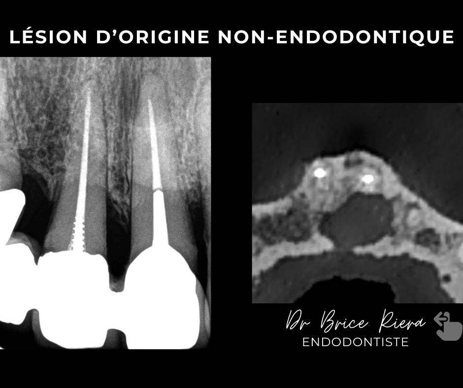 1 lesion non endodontique