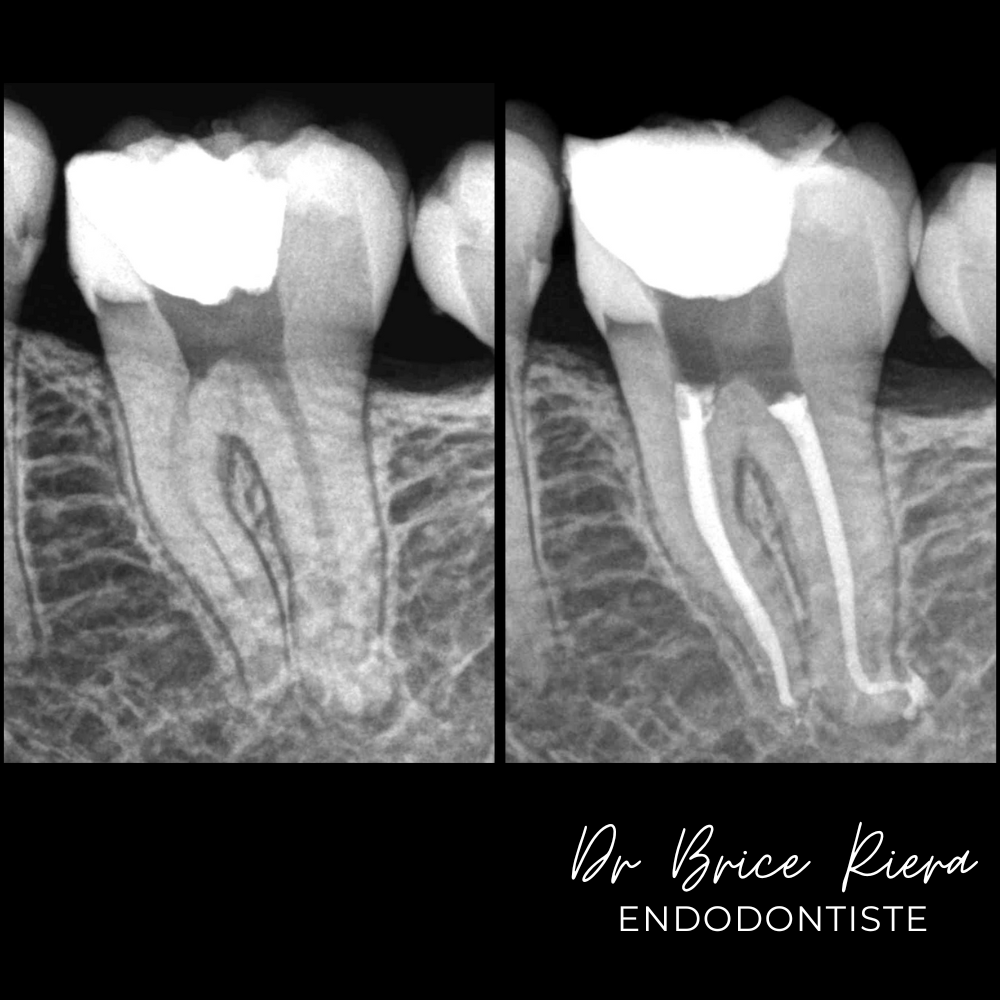 2 - atcd pulpotomie d urgence