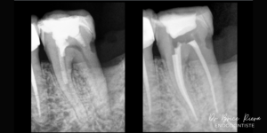 Dents traitees extraites - dr brice riera 1