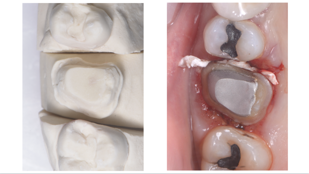 Effet Ferrule 1 - Dr Brice RIera