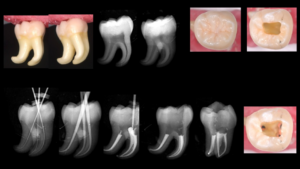 Image FB simple - 60 dents 40 molaires