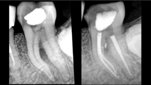 Les limites des radios retroalveolaires - dr brice riera 2