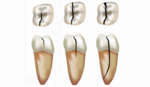 Photo mise en avant blog Dr Brice Riera - felure fractures dentaires