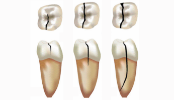 Photo mise en avant blog Dr Brice Riera - felure fractures dentaires