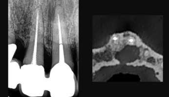 Photo mise en avant blog Dr Brice Riera - lesion non endodontique