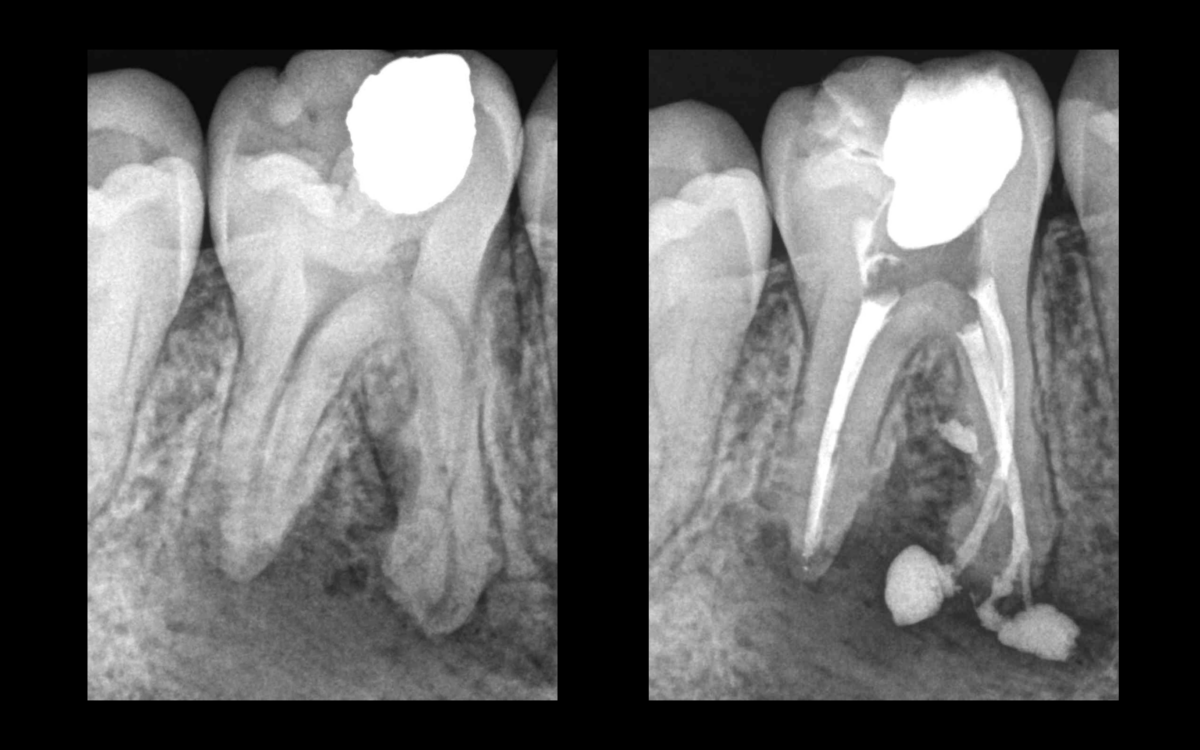 diagnostic necrose pulpaire - dr brice riera 1