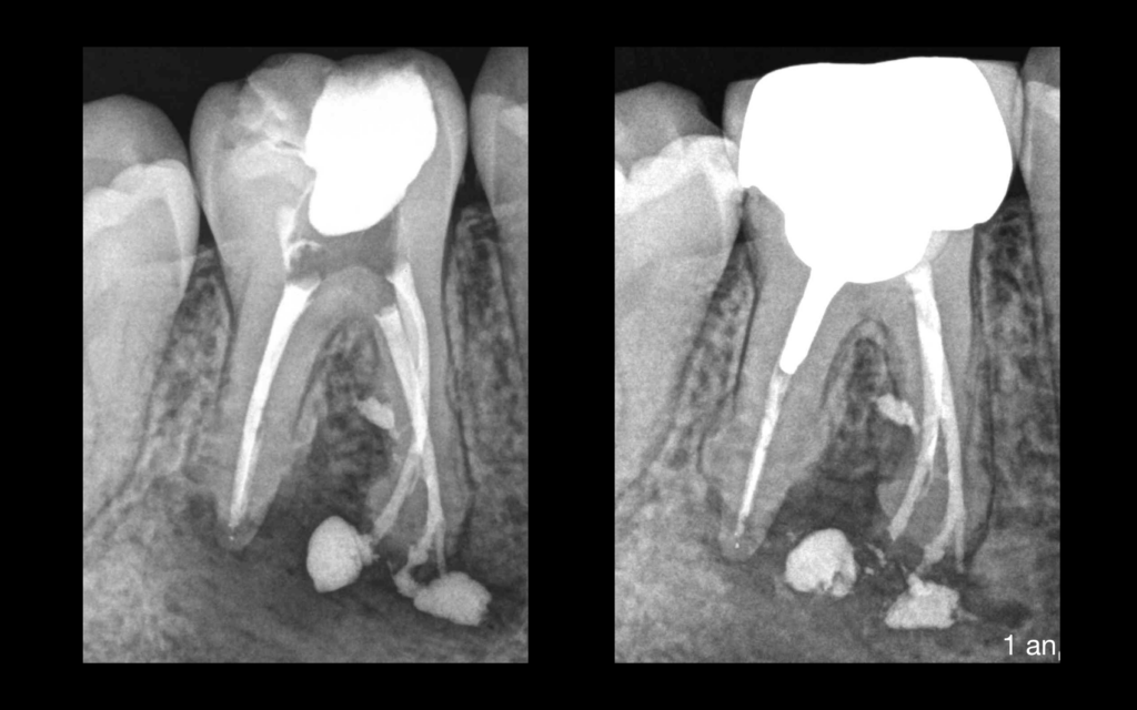 diagnostic necrose pulpaire - dr brice riera