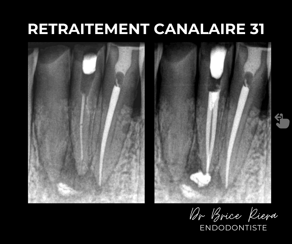 1 - Retraitement 31 - Dr Brice Riera