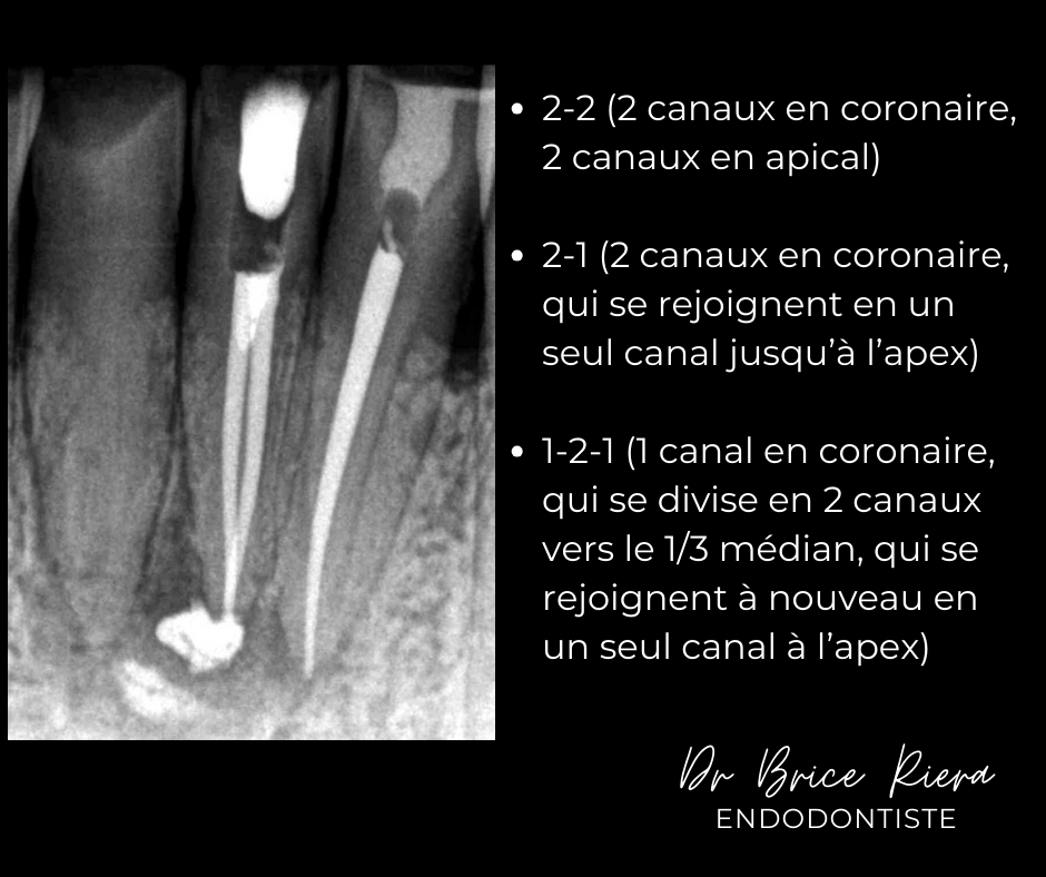 3 - - Retraitement 31 - Dr Brice Riera