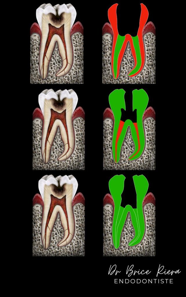 Thread - travail de la dentine