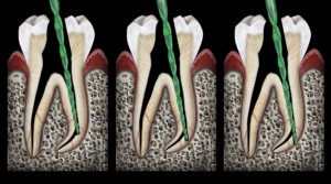 instrument endodontie trop rigide - dr brice riera