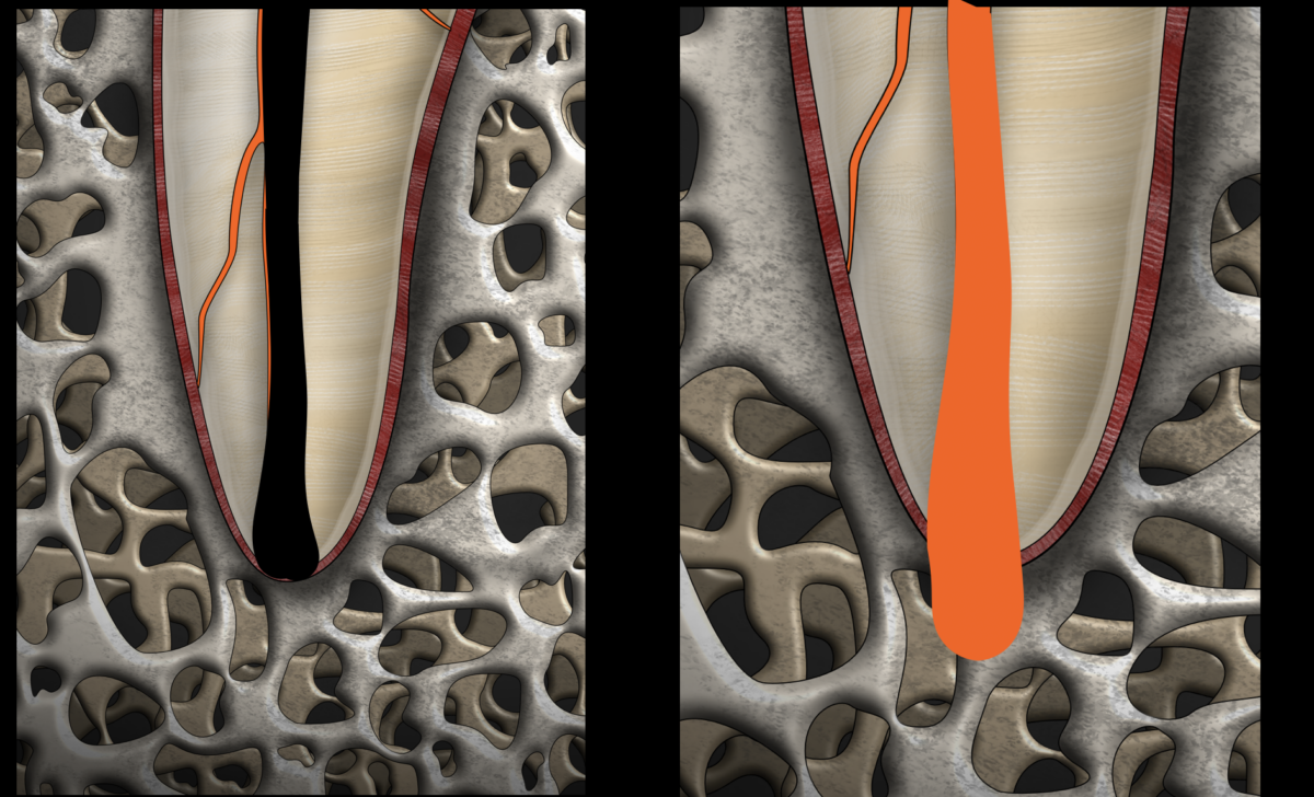 mise en avant blogtiktok - dr brice riera - diametre apical