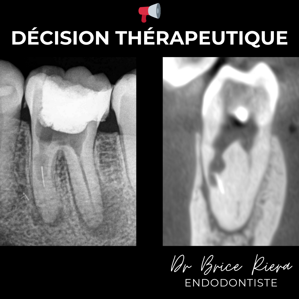 1 - Dr Brice Riera - decision therapeutique