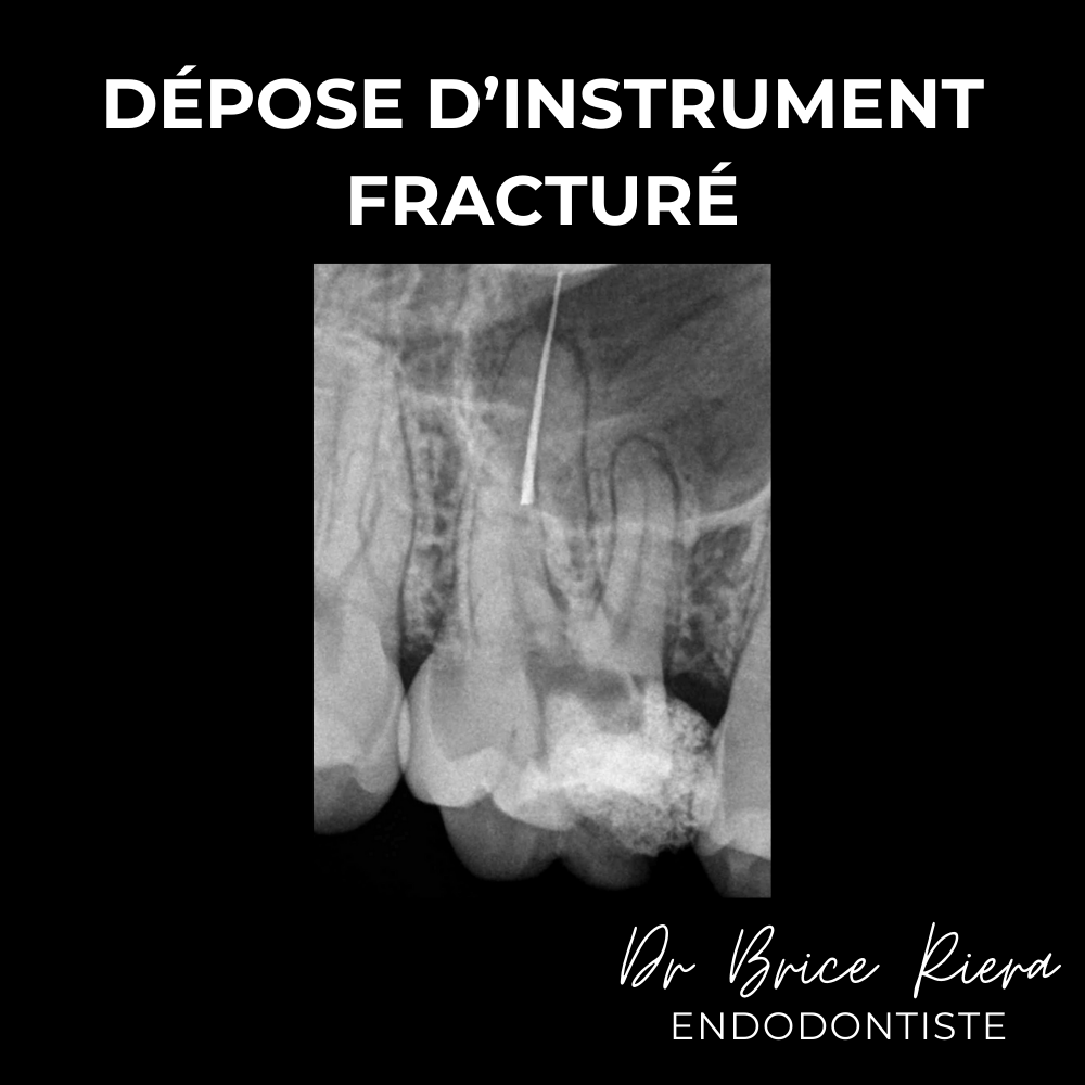 Dr Brice Riera - depose d un instrument fracture1