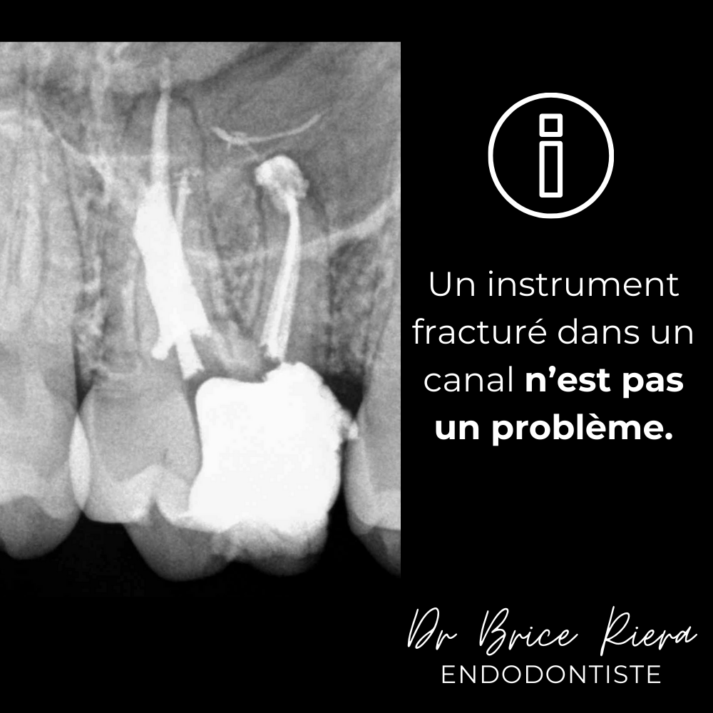 Dr Brice Riera - depose d un instrument fracture2