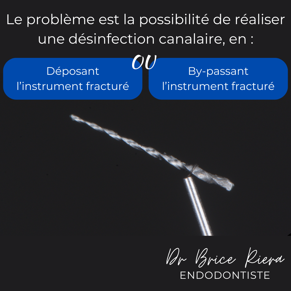 Dr Brice Riera - depose d un instrument fracture2