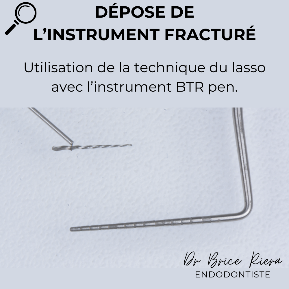 Dr Brice Riera - depose d un instrument fracture2