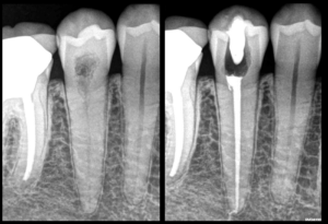 blog - dr brice riera - Résorption radiculaire externe cervicale