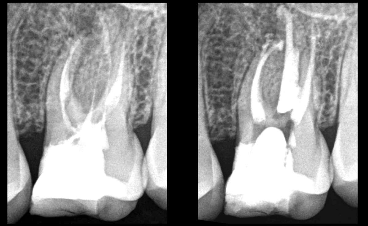 blog - dr brice riera - depose tenon fibre