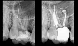 blog - dr brice riera - instrument fracture