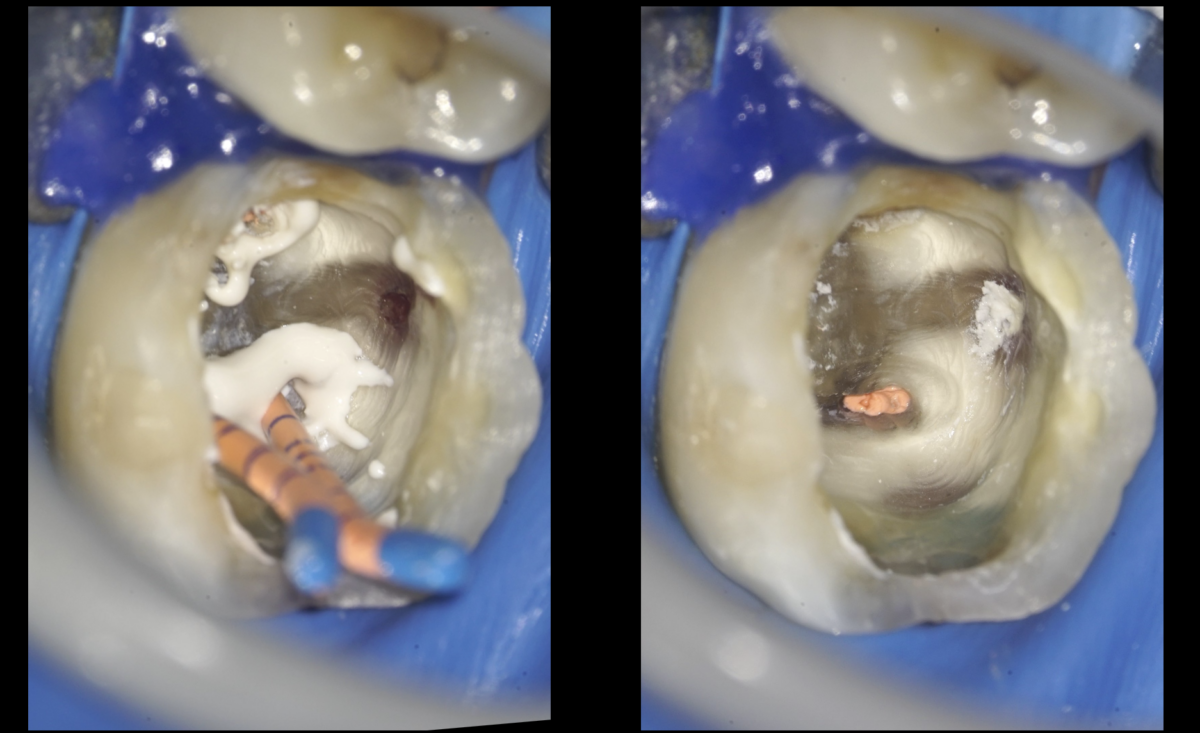 blog - dr brice riera - perforation