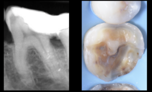 blog - dr brice riera -restauration dent depulpee