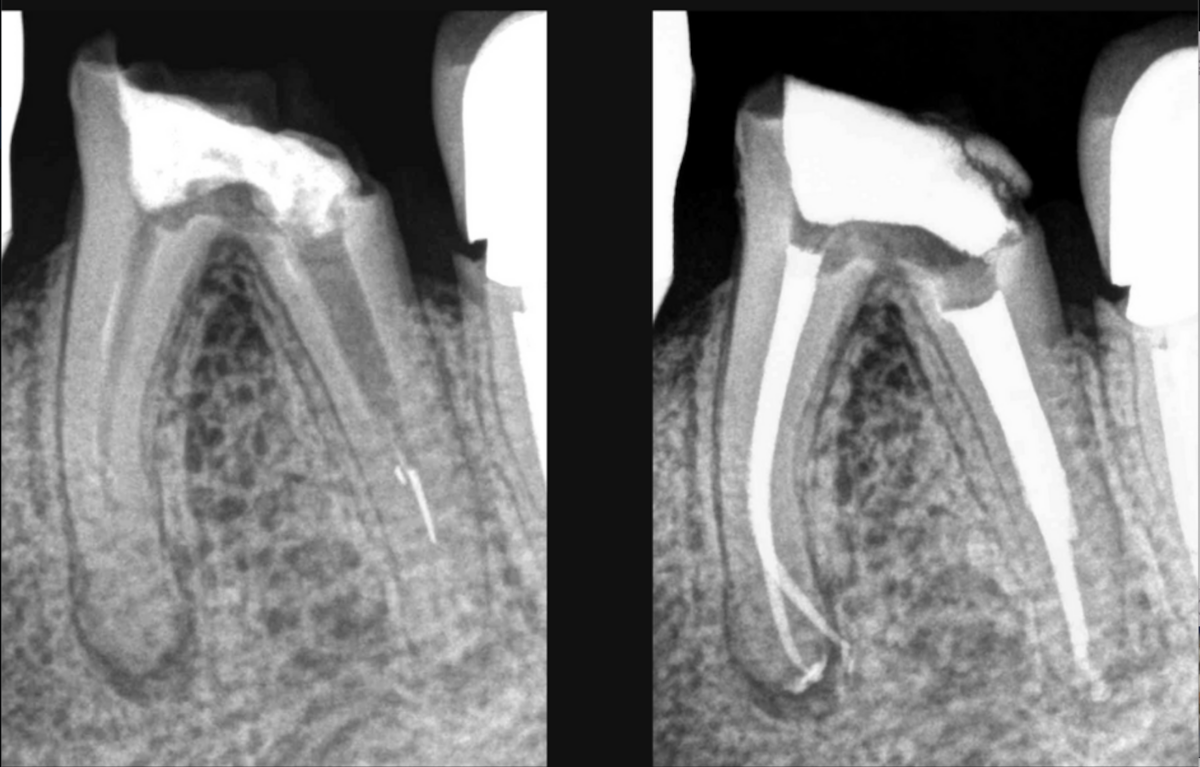 blog - dr brice riera - retraiter ou extraire