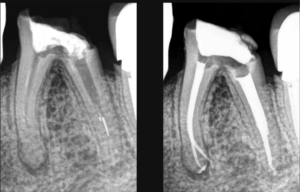 blog - dr brice riera - retraiter ou extraire