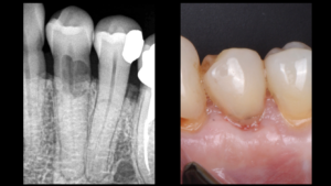 BLOG - dr brice riera - cas osteoporose severe