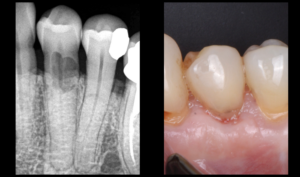 blog - dr brice riera - biphosphonate