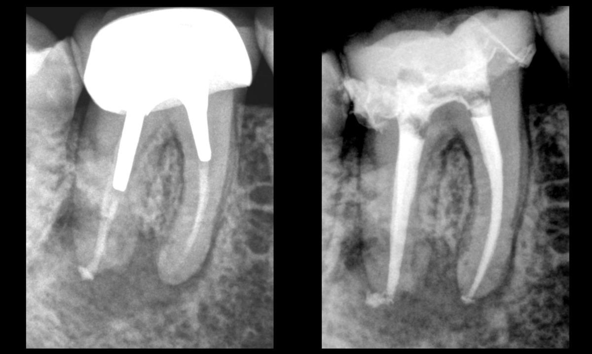 blog - dr brice riera - role de l obturation