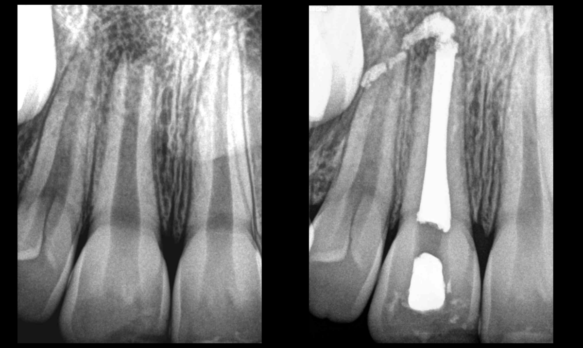 Blog - Dr Brice Riera - DPI et endodontie